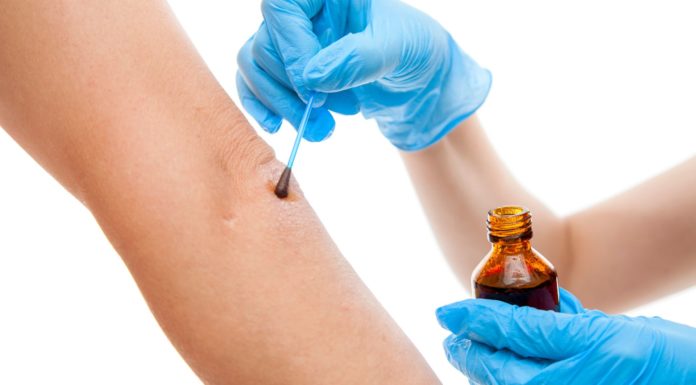 Йод и йодовая сетка для лечения заболеваний