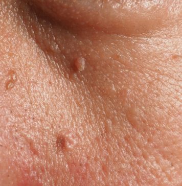 Средства и травы от вируса папилломы