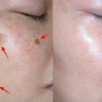 пигментные пятна