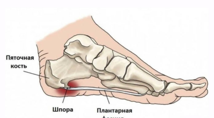 8 народных рецептов лечения пяточной шпоры!
