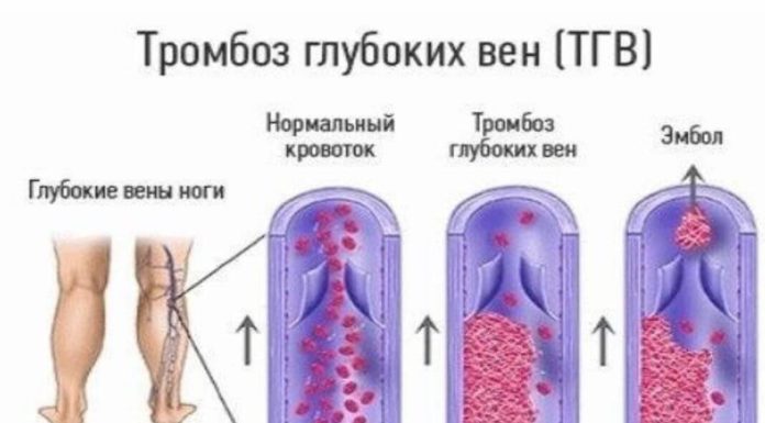 Чем опасны артериальный и венозный тромбоз?