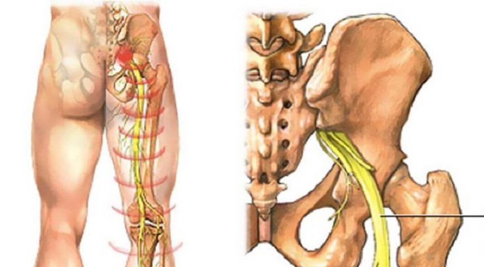 Метод Спать-Сидеть-Стоять от болей седалищного нерва