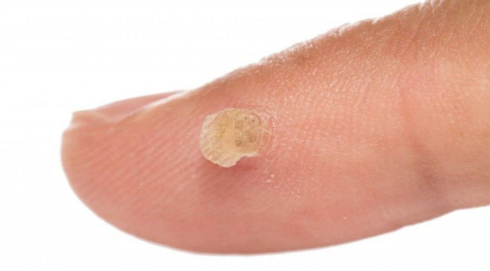 Вывести бородавки помогут народные рецепты!