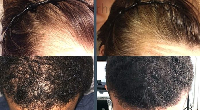 Руководство от выпадения волос, от облысения, уход за волосами