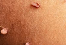 Что такое папилломы, как удалять домашними средствами