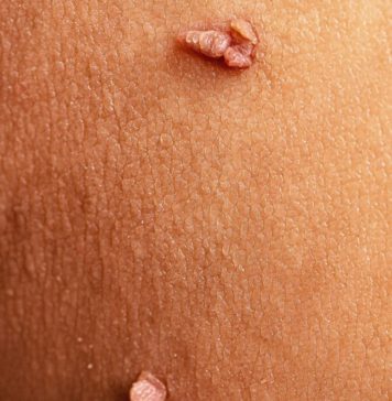 Что такое папилломы, как удалять домашними средствами