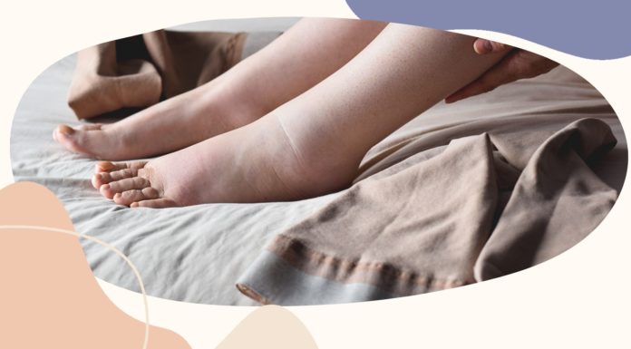 Почему появляются отеки, как избавляться от отеков?