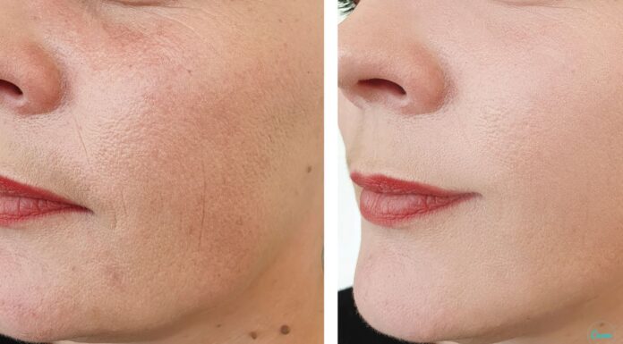 Сосудистые звездочки – как сделать кожу здоровой!