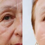 SMAS-лифтинг: Эффективное омоложение и подтяжка лица