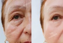 SMAS-лифтинг: Эффективное омоложение и подтяжка лица