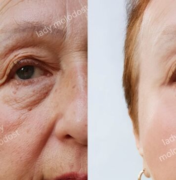 SMAS-лифтинг: Эффективное омоложение и подтяжка лица