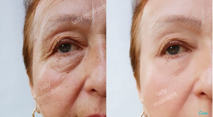 SMAS-лифтинг: Эффективное омоложение и подтяжка лица